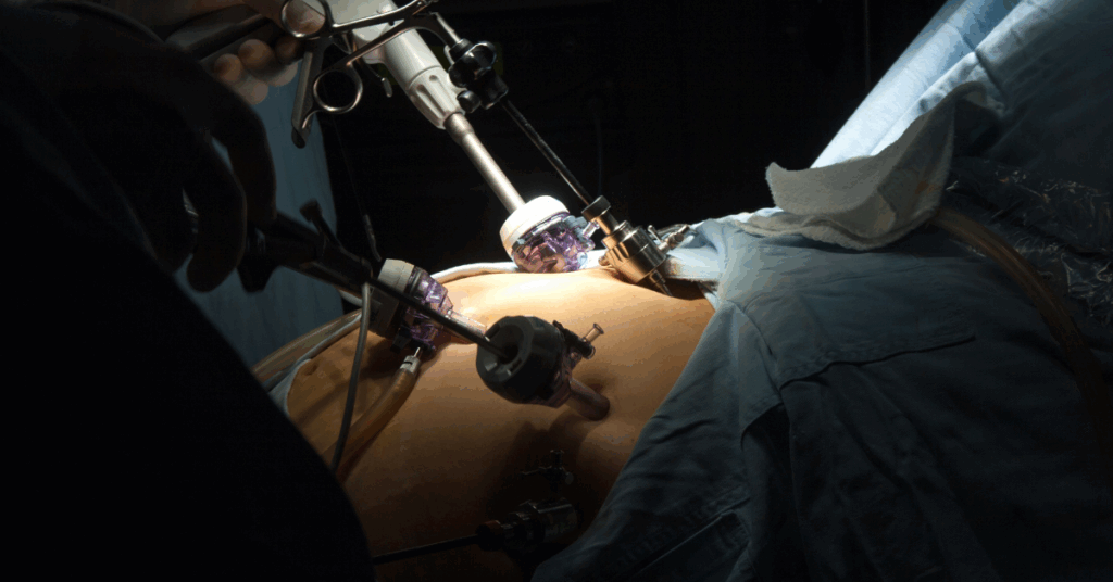 Five myths of the gastric balloon procedure