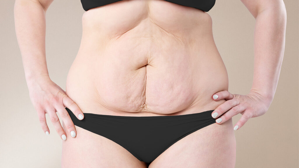surgery after weight loss